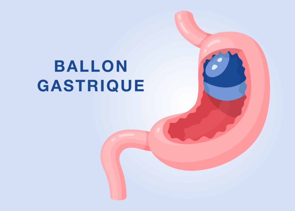Ballon gastrique à Paris IOPC Institut de l'obésité Paris Centre — free download
