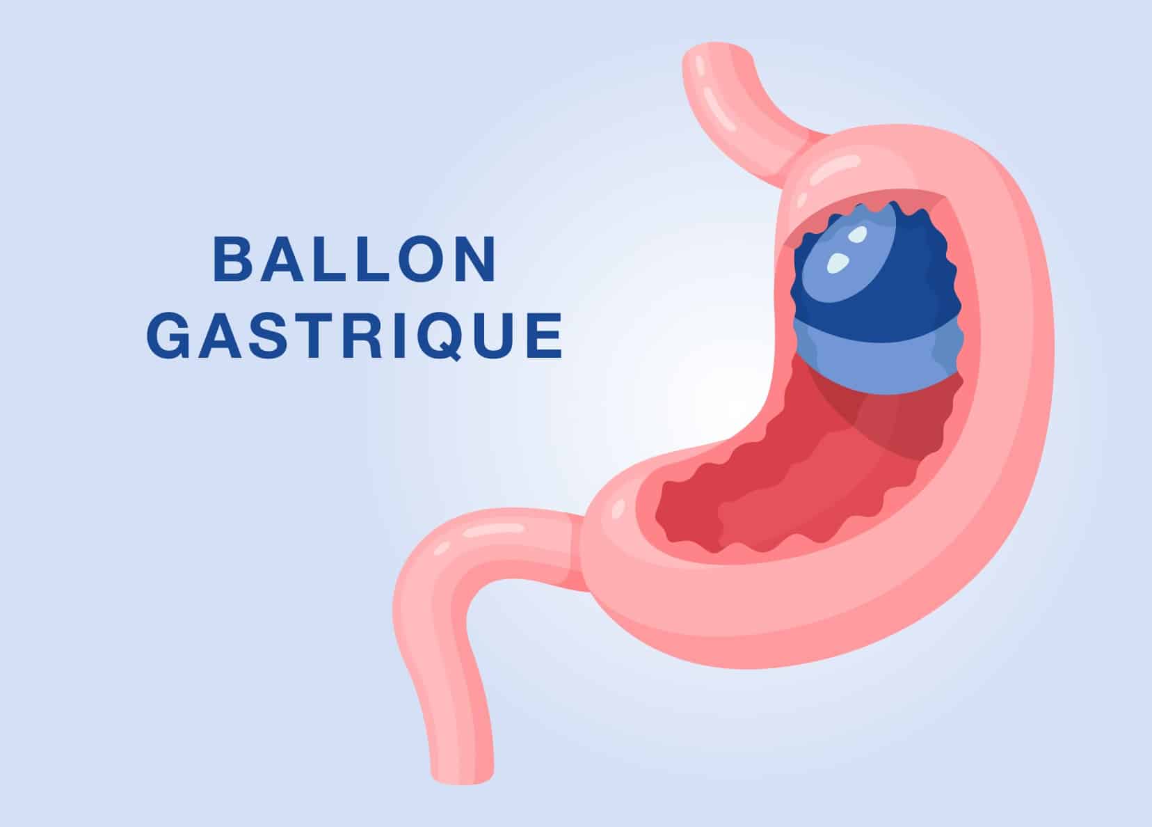 Ballon gastrique à Paris | IOPC | Institut de l'obésité Paris Centre