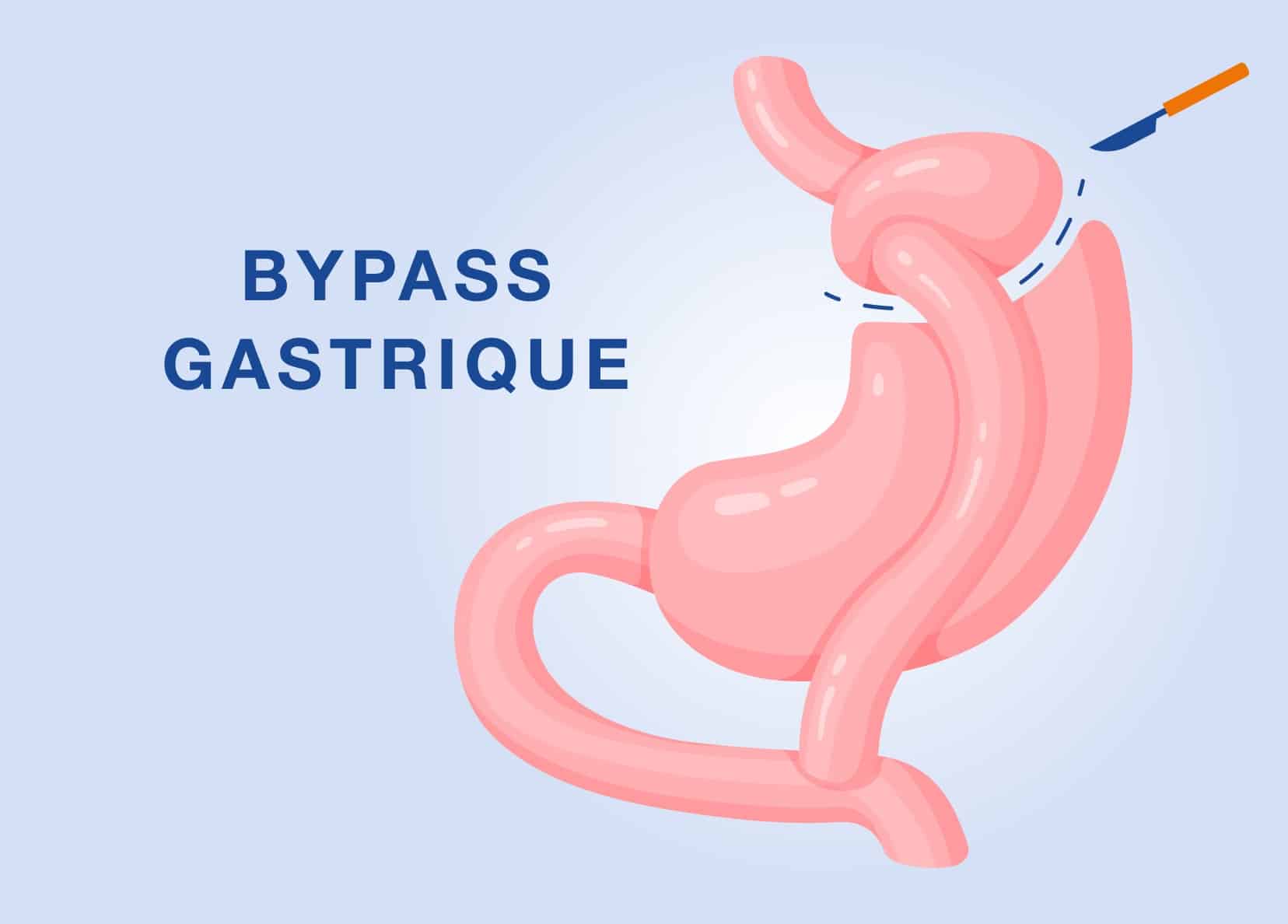 Bypass gastrique à Paris | IOPC | Institut de l'obésité Paris Centre
