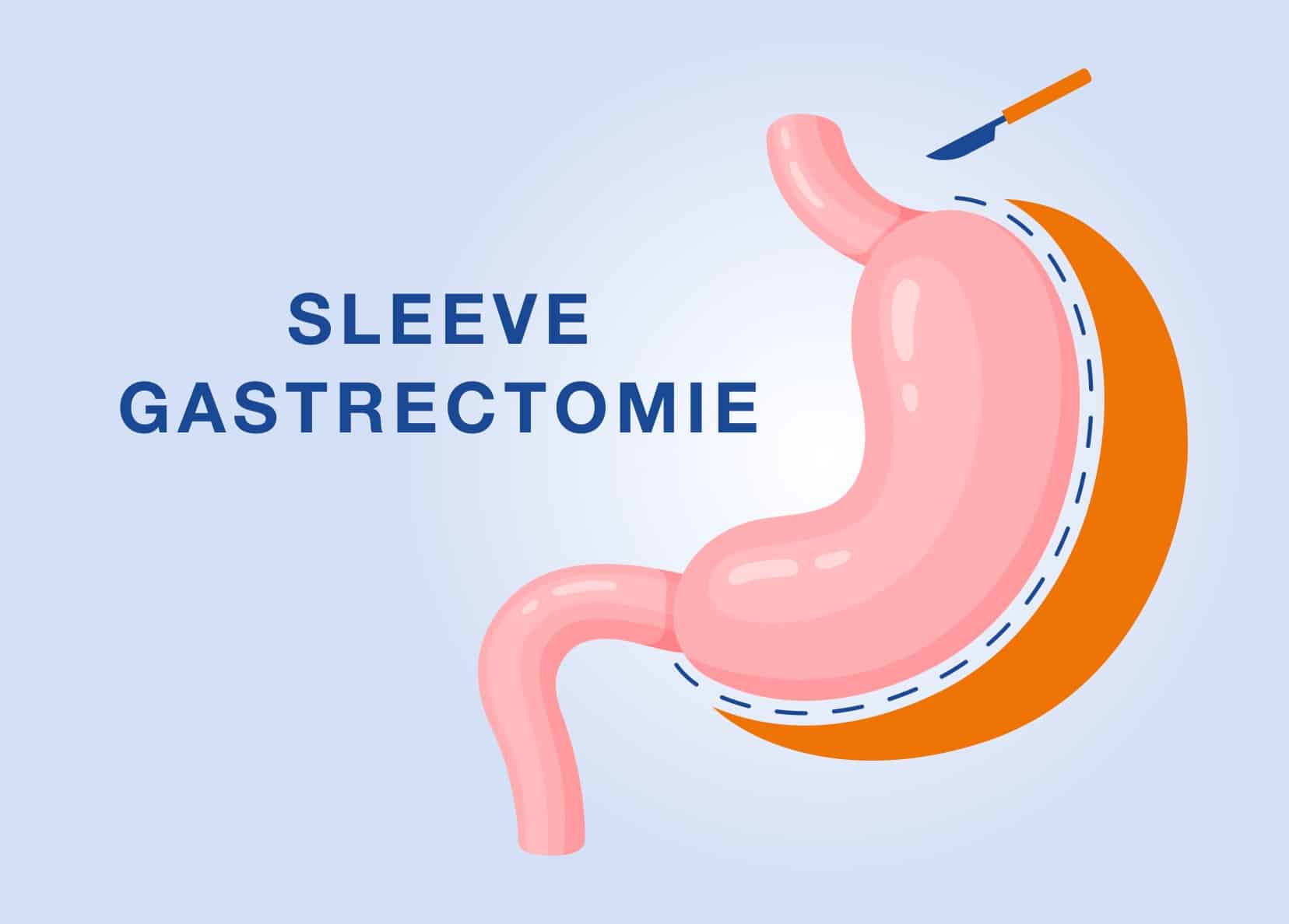 Sleeve gastrectomie à Paris | IOPC | Institut de l'obésité Paris Centre